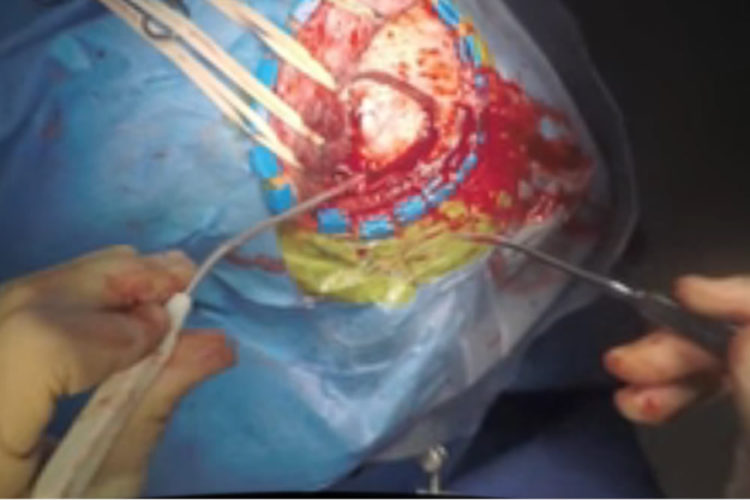 Vidéo 360 degrés chirurgie anévrismes