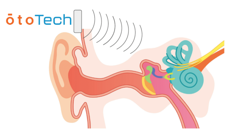 ototech fonctionnement