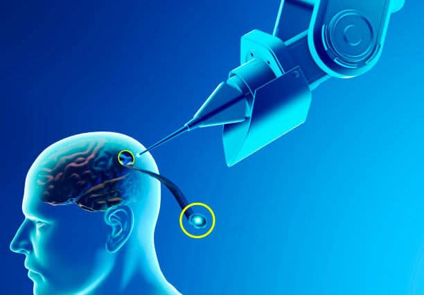 La start-up Neuralink fait un pas en avant