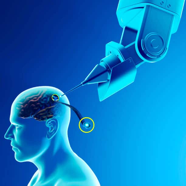 La start-up Neuralink fait un pas en avant